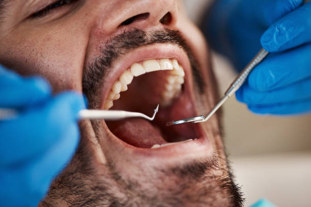 Best Emergency Dental Care for Broken or Chipped Teeth in Menifee, CA
